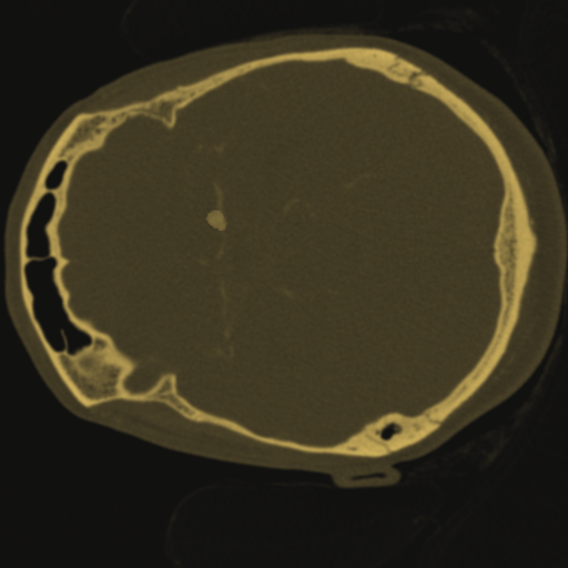 Aneurysm segmentation case frame